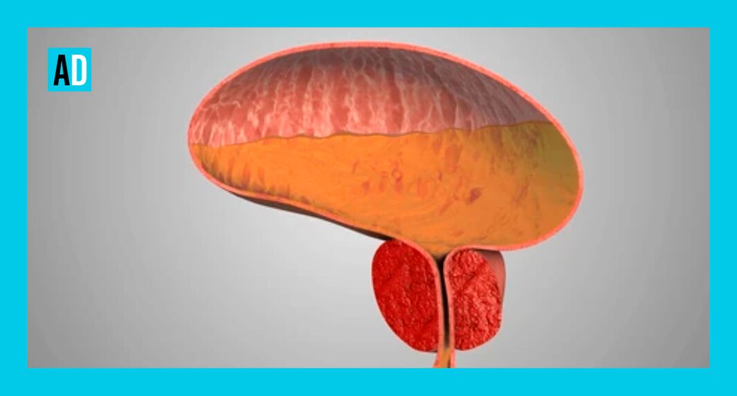 Glándula prostática inflamada